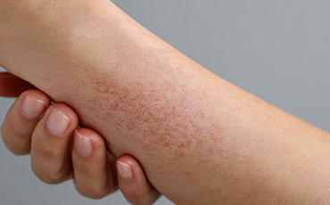 피부 면역 리셋